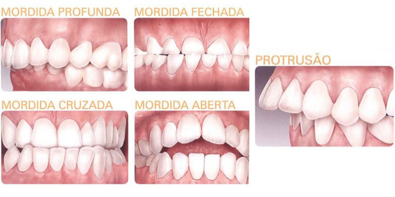 Cinco imagens apresentando diversos tipos de mordida:  a profunda, a fechada, a cruzada . a aberta e a protusão.